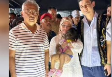 Ratu Malaysia Tawarkan Adopsi Gadis 2 Tahun dengan Sindrom Manusia Serigala Tanpa Hidung