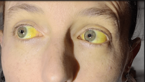 Seorang Ibu Mengonsumsi Produk Herbal untuk Atasi Menopause, Matanya Berubah Menjadi Kuning Bercahaya