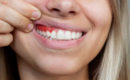 Penyakit Gusi Dapat Sebabkan Gigi Tanggal dan Memperburuk Kesehatan