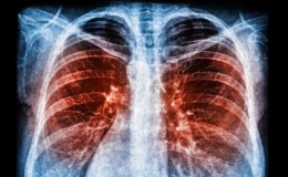 Paru-paru Basah, Mitos dan Penyebab Timbulnya Cairan Menurut Ahli Paru