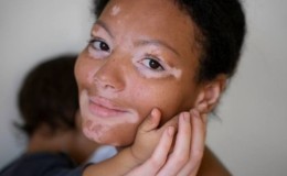 25 Juni Adalah Hari Vitiligo Sedunia: Mengenal Vitiligo dan Cara Merawatnya