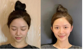 Wanita Tiongkok Mendambakan `Telinga Peri` Agar Terlihat Cantik